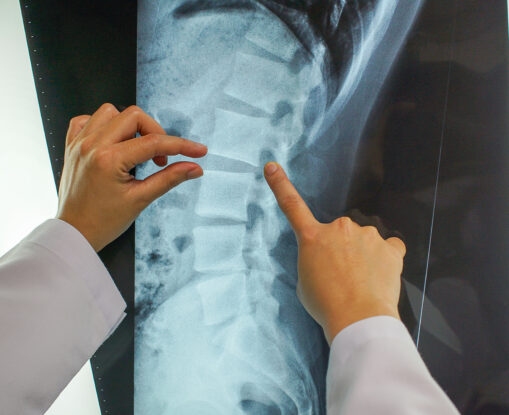 What Makes a Brain or Spinal Injury “Catastrophic” in Legal Terms?