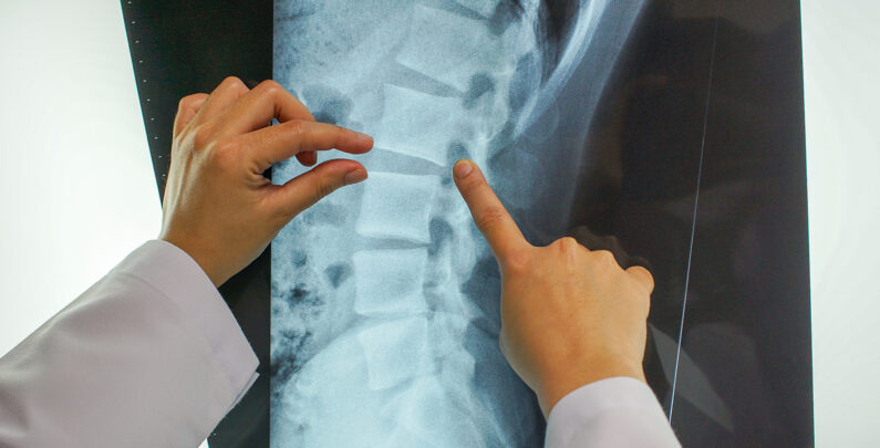 What Makes a Brain or Spinal Injury “Catastrophic” in Legal Terms?