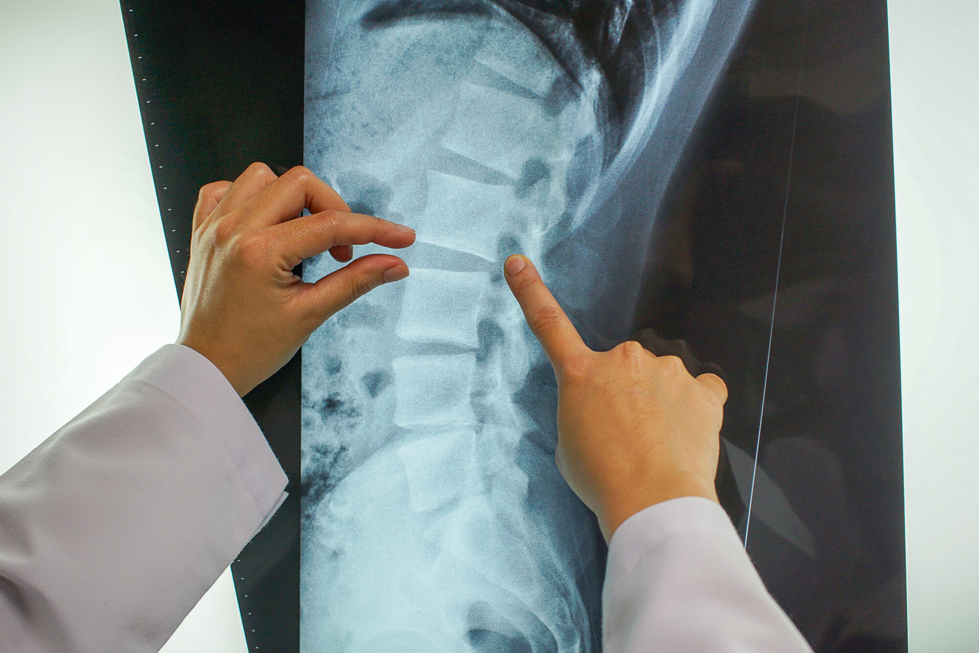 When Brain or Spinal Injuries Are Legally Classified as Catastrophic